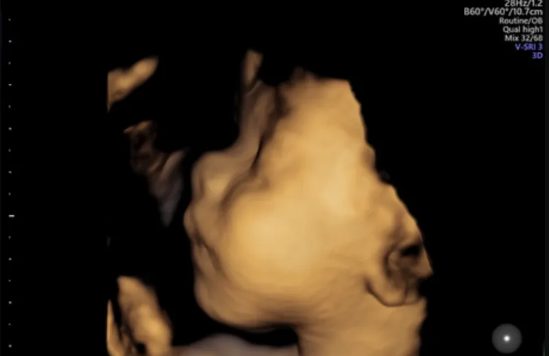 Kønsscanning (Pakke 2) hos Klinik A-SCAN