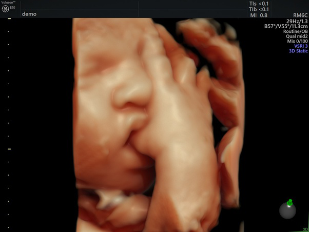 3D / 4D HD-LIVE hos Klinik A-SCAN