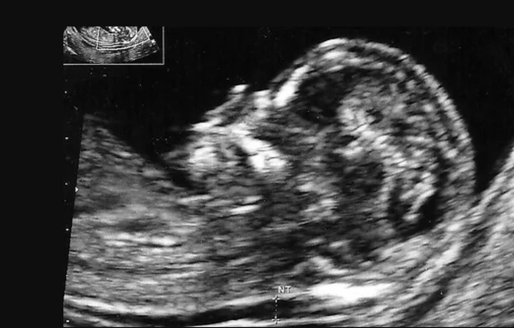 Nakkefoldsscanning hos Klinik A-SCAN