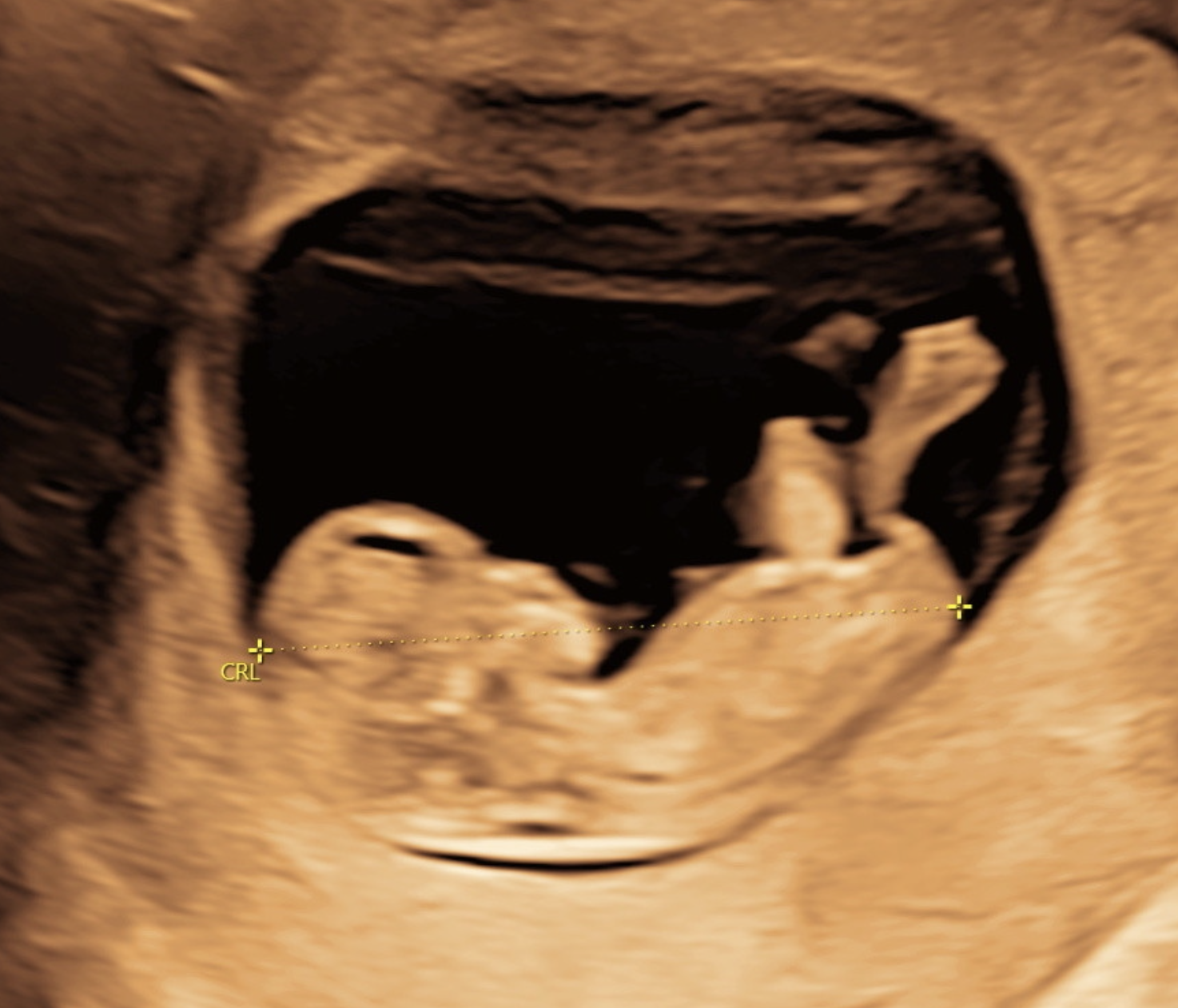 Tidlig Scanning hos Klinik A-SCAN