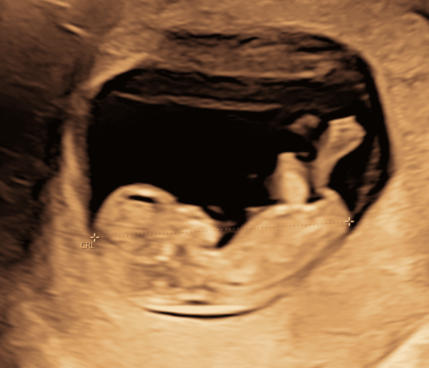 Graviditetsscanning, kønsscanning, nakkefoldsscanning, tidlig scanning, 3d scanning baby, 3d scanning gravid, ultralydsscanning,